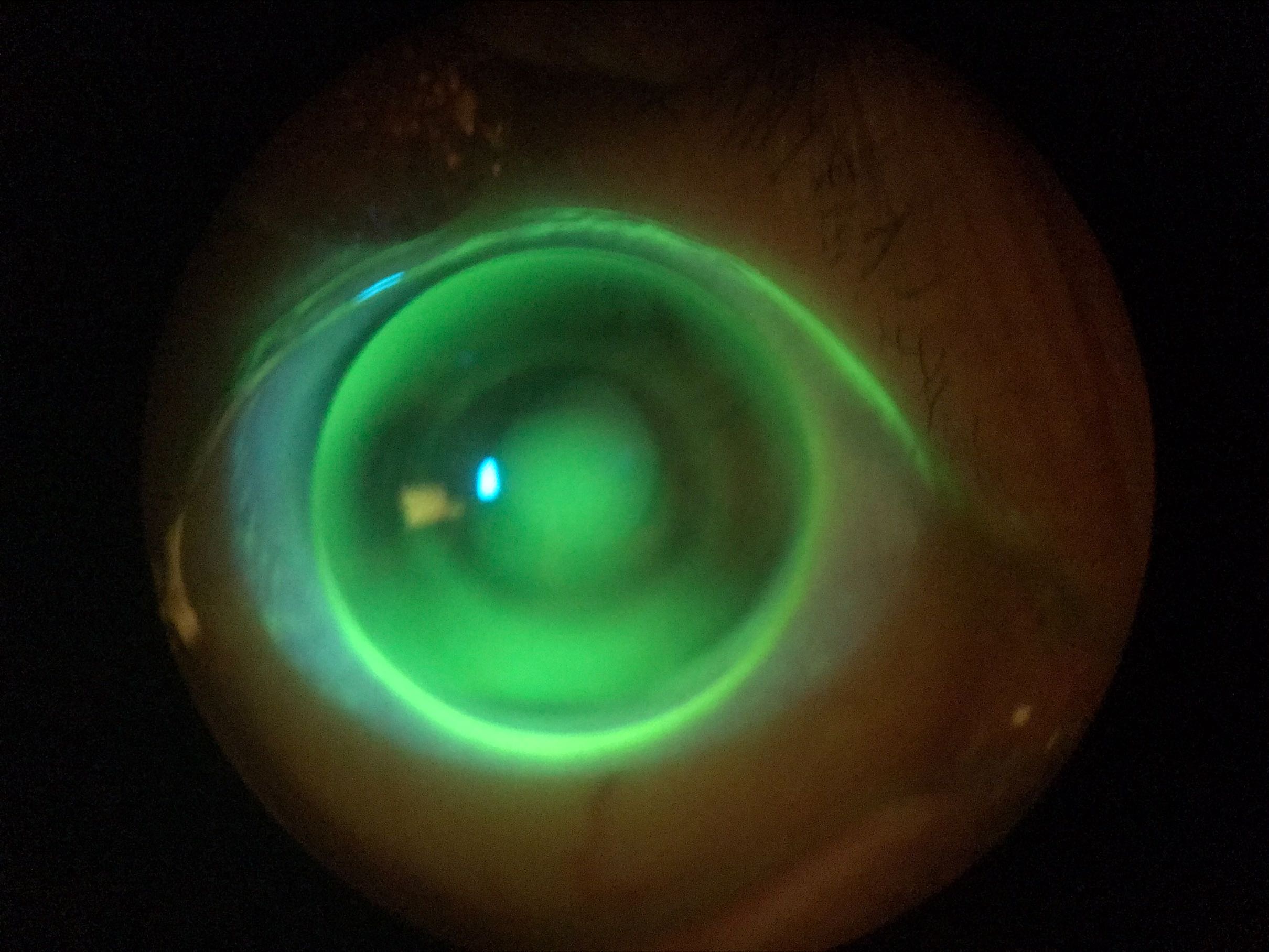 Hyperopic Presbyopia Ortho-K