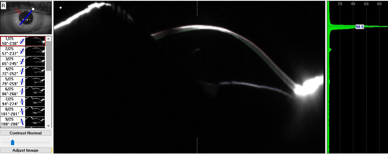 Pentacam 3D Eye Model