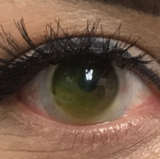 
                  Sceral lens on an eye with advanced keratoconus