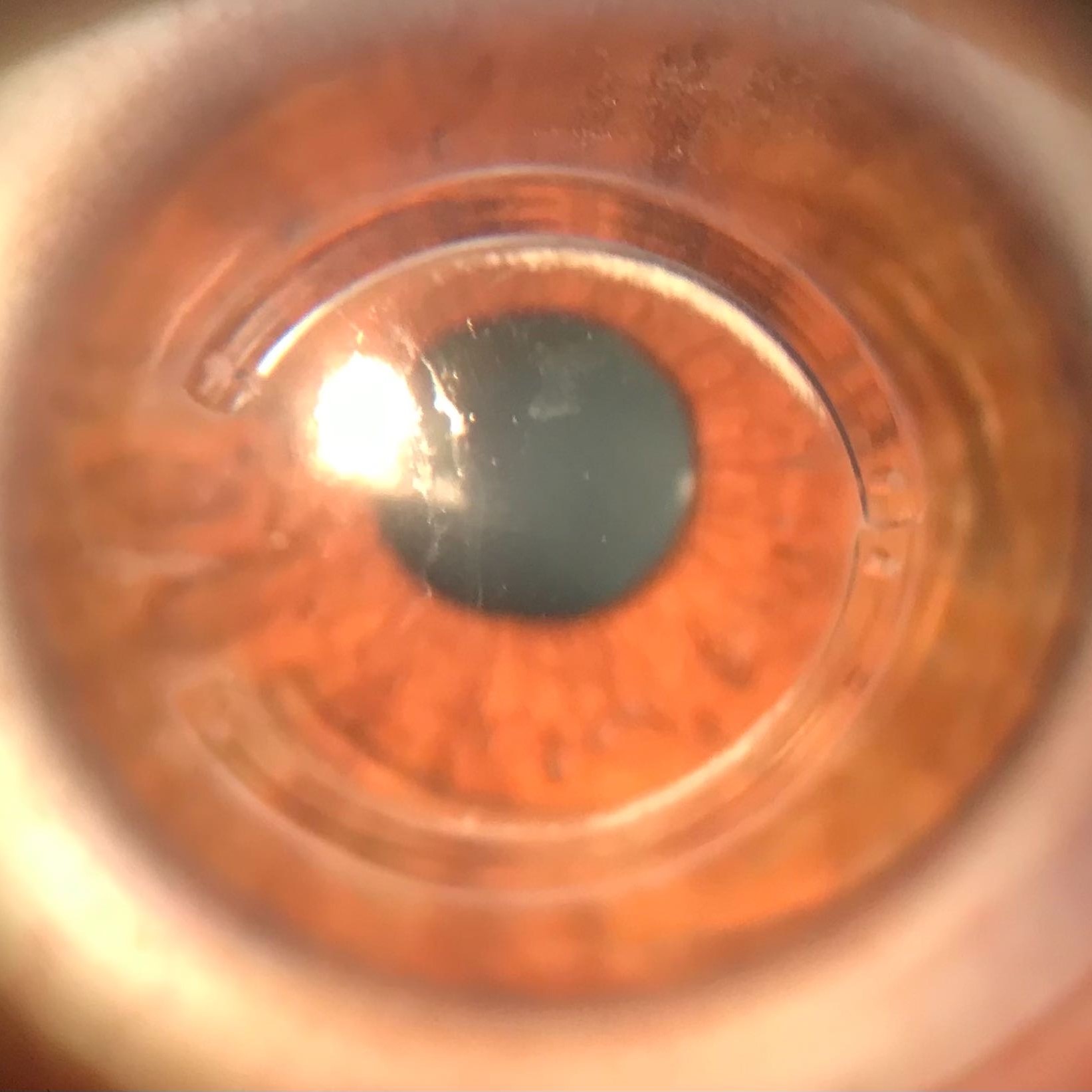 scleral contact lenses keratoconus