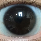 
                  Sceral lens on an eye with moderate keratoconus